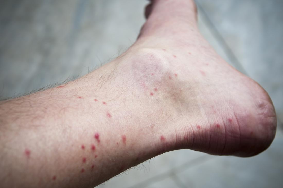 What Does A Dengue Fever Bite Look Like