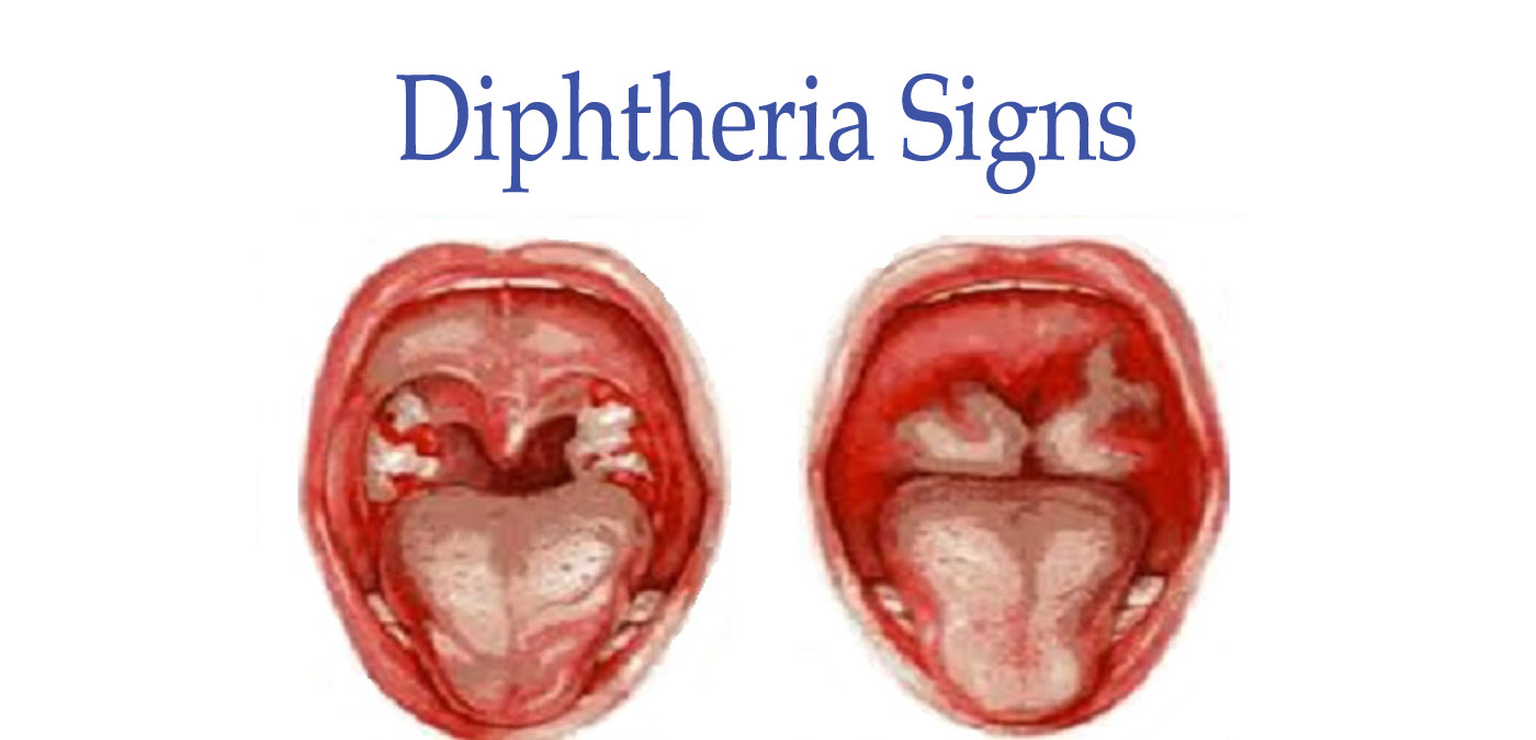 Diphtérie: causes, symptômes et traitement