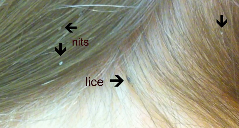 https://fmedic.org/wp-content/uploads/2020/12/head-lice-actual.jpg