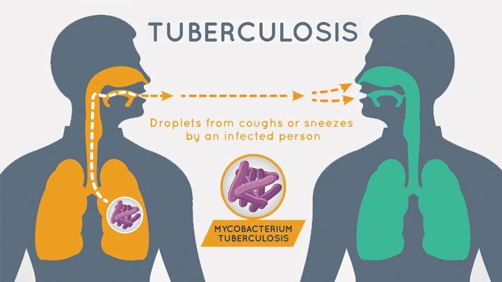 Tuberculose: causes, symptômes et traitement