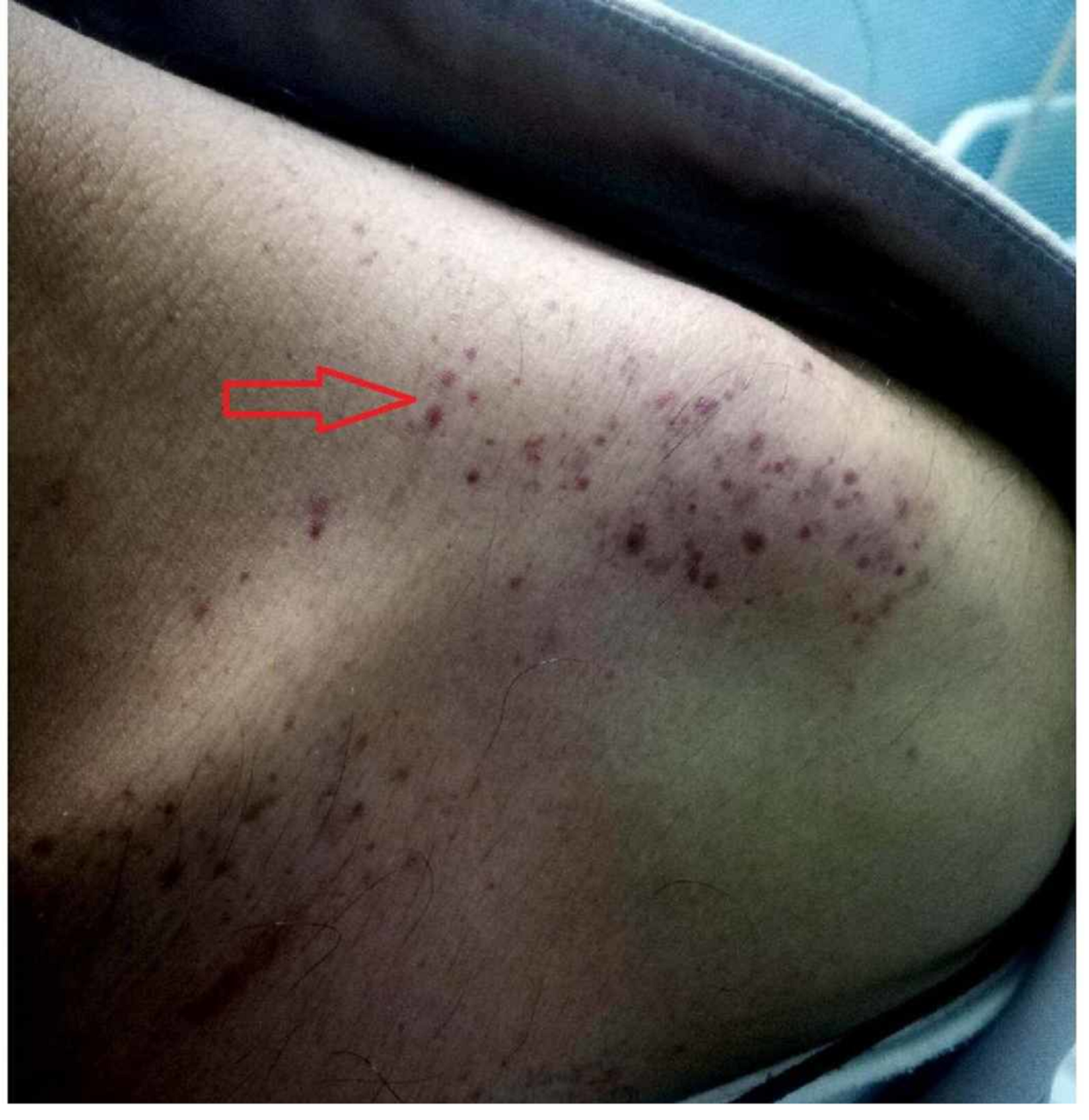 Purpura et pétéchies multiples sur l'épaule gauche d'un patient atteint de dengue